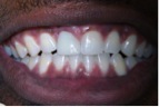 After-DentalImplants-2