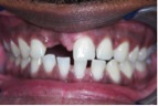 Before-DentalImplants-2