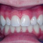 dental-implants-richview-family-dentistry